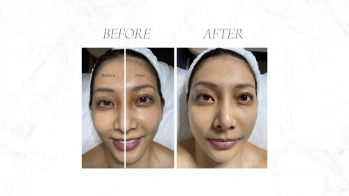 Bojin Facial Treatment – Carragheen